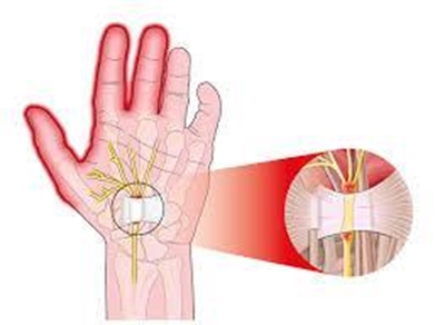 What is carpal tunnel syndrome?